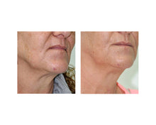 Load image into Gallery viewer, Decollete & Neck - 3 Sessions