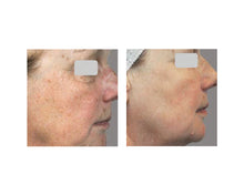 Load image into Gallery viewer, Photo Facial - 3 Sessions